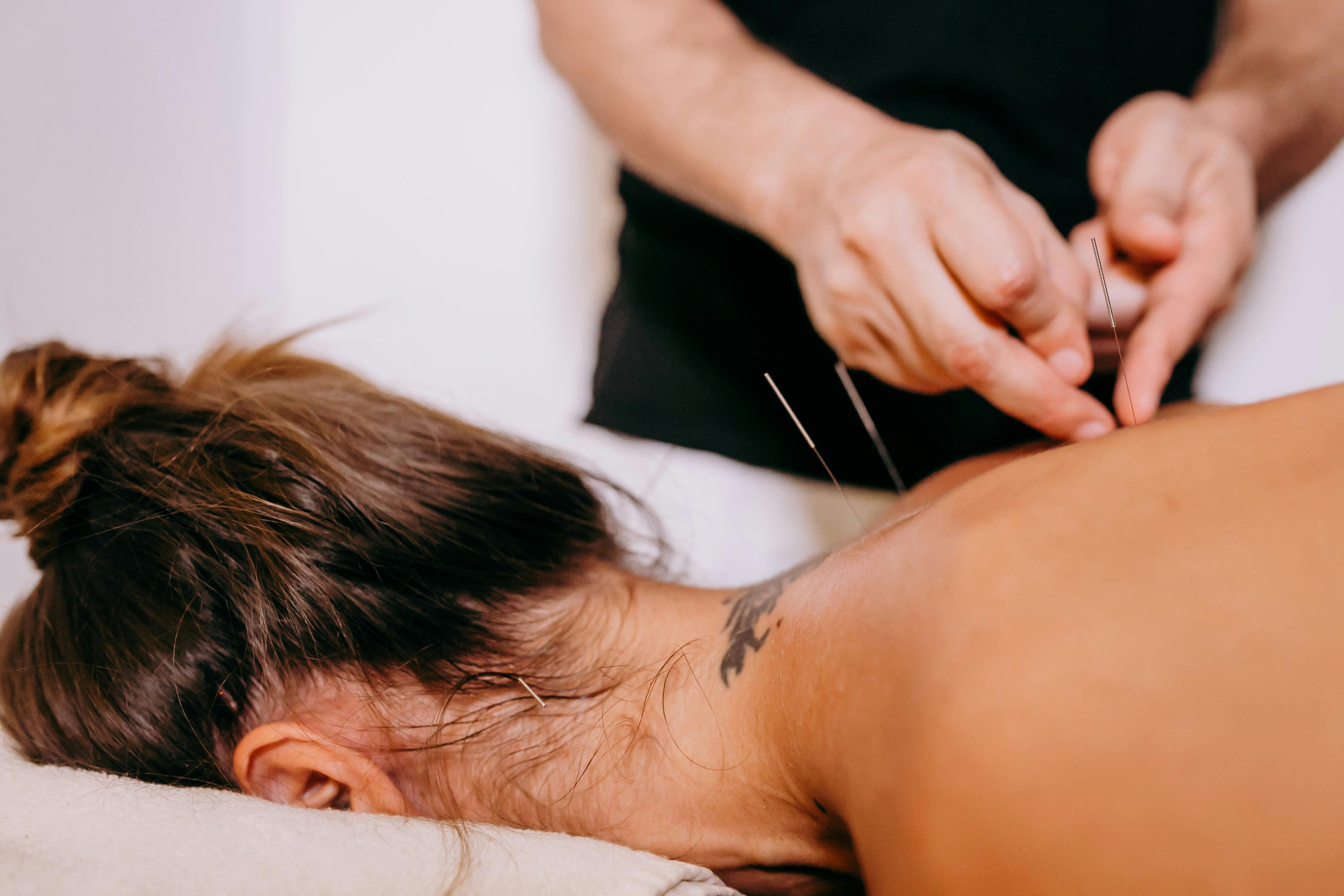 Acupuncture treatment at Topegene Longevity
